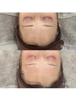 ラ フルール(La Fleur)/エアバリフェイシャル