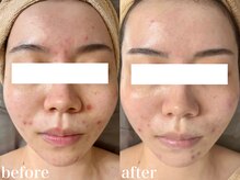 ホワイトアクア 北千住店(WHITE AQUA)/ハーブピーリング/ニキビケア