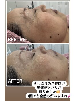 エスプラス エヌプラス(S+/N+)/フェイシャルエステ　ビフォアフ