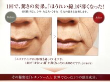 エルムの雰囲気（結果重視★大人の本気コース1回で確かな肌実感ピュアレチノール）