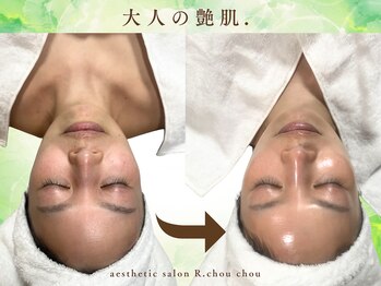 アール シュシュ(R.chouchou)の写真/大人の艶肌・水光プログラムでどこからも見ても超美肌。死角なし！ダウンタイムなし剥離なしピリつきなし！