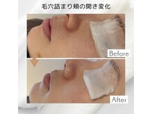 リアン(Lien)/【症例】毛穴洗浄 1回の変化