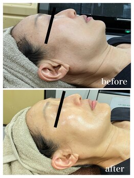 ジャスミン(Jasmin)/臍帯血幹細胞×NMN×AC-11