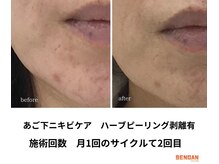 洗顔サロン 池袋(SENGAN)/剥離ハーブピーリング　