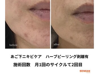 洗顔サロン 池袋(SENGAN)/剥離ハーブピーリング　