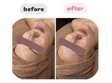 ララ(LALA)/韓国最新美容ララピールで水光肌