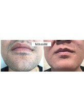 キザシ(kizashi)/髭脱毛で営業成績アップ？