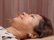 フィーカ/美容鍼