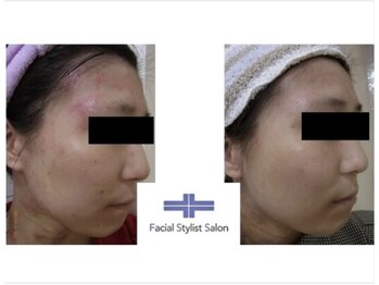 フェイシャルスタイリストサロン 四谷店/ケア例(40)