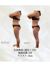 カリス(charis)/全身痩身　初回体験