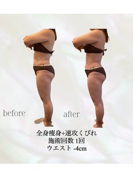 カリス(charis)/全身痩身　初回体験