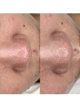 アロマ(AROMA)/黒ずみ毛穴(4)