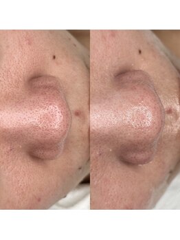 アロマ(AROMA)/黒ずみ毛穴(4)