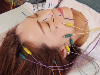 朋整骨院の写真/【県内希少な立体造顔美容鍼】リフトアップ・目の下のたるみケア等難易度の高い悩みにも◎