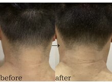 スパイリーア(Spiraea)/男性うなじBeforeAfter