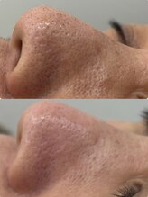 アール(R)/【 毛穴洗浄×ジェリーマスク 】