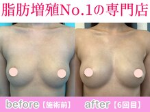 サラエクセレント 天王寺(SARA EXCELLENT)/ふっくらおわん型に♪バストケア