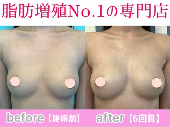 サラエクセレント 天王寺(SARA EXCELLENT)/ふっくらおわん型に♪バストケア