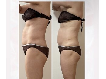 サロン アンネ(Anne)/ウィンバック痩身