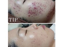 繰り返す肌荒れに終止符。本気の肌改善TIPハーブピーリング/折尾