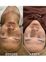 #美容革命ラボ 福岡春吉店/毛穴洗浄【春吉・天神】