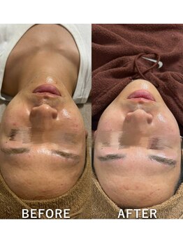 #美容革命ラボ 福岡春吉店/毛穴洗浄【春吉・天神】