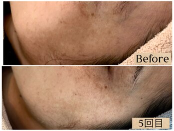 ルアナ 柏店(LUANA)/シミケア経過例(5回目)