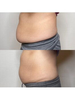 プルメリア(Plumeria)/経過☆