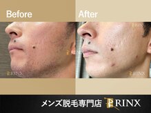 リンクス 秋田駅前店(RINX)/ヒゲ脱毛《メンズ脱毛RINX》