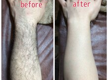 脱毛サロン ベル(Bell)/1回でこの効果！