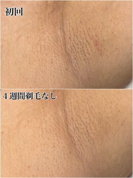 ルシャトン(Le Chaton)/ワキ脱毛