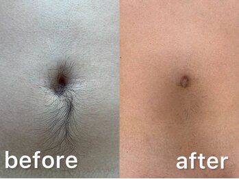 ウィステリア(WISTERIA)/ギャランドゥ脱毛