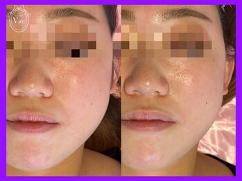 ハーブピーリング 名古屋/光ピール施術　肌質改善