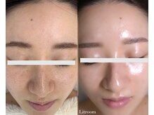 リトルーム(Litroom: from Seoul)/毛穴もくすみもここまで変わる。