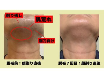 ウルル(Ululu)/【メンズ脱毛】肌の変化