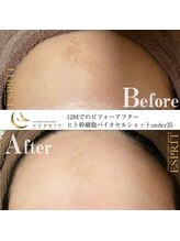 エスプリ 新宿店/ハーブピーリング新宿