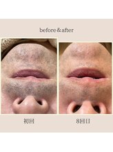 キッキー(Kicky)/濃いおヒゲ7～8回目で劇的変化