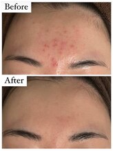 サロン アンス(anse)/ハーブピーリング