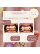 プラスビー 2号店(+b)/ホワイトニングビフォーアフター