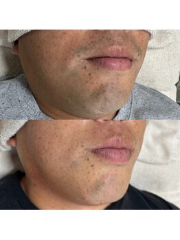 アンドエス(&S.)/ひげ脱毛10回☆