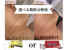 ハッピーエンジェル(Happy Angel)の雰囲気（選べる【レモンボトル進化版REDSHOT】脂肪分解液＋引き締め美肌）