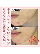 アルムダアクア 天王寺店(Aleumda AQUA)/ハーブピーリング/大阪/天王寺