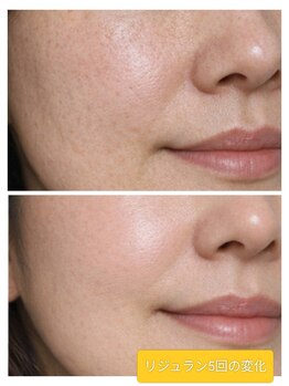 縁(en)/リジュラン5回の効果!変化!