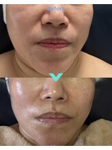 ミルキー(Milky)/産毛、皮脂、垢、たるみ、美白