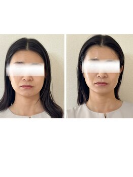 ビオラ(ola)の写真/憧れの小顔へ導く本格ケア◎大人女性のエイジングケアにもおすすめです！