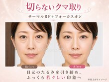 オリエンタルローザ 表参道(Oriental Rosa)/切らないクマ取りで目元の影解消