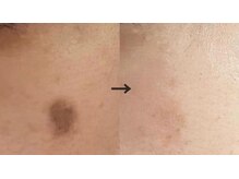 ラエッセ 恵比寿(LAESSE)/毛穴・美白専門店 LAESSE 恵比寿