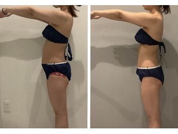 美容整骨小顔ラボ/ハイパーナイフ痩身