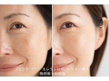 トータルエステティックサロン ヴィーナス(Venus)/COエレクトロポーレション導入