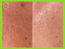 ヴィオール 名古屋栄店(VIOR)/1回でも毛穴が変わる♪